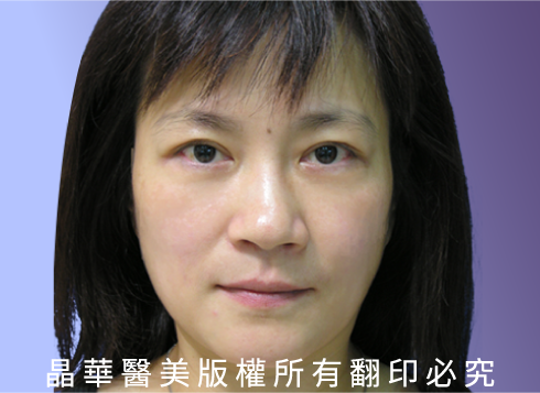 台北、桃園晶華醫美臉部拉皮整形手術推薦 內視鏡隱痕拉提手術案例照片